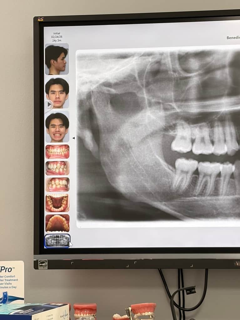 invisalign